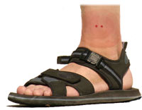 לוכד נחשים: מה עושים במקרה של הכשה